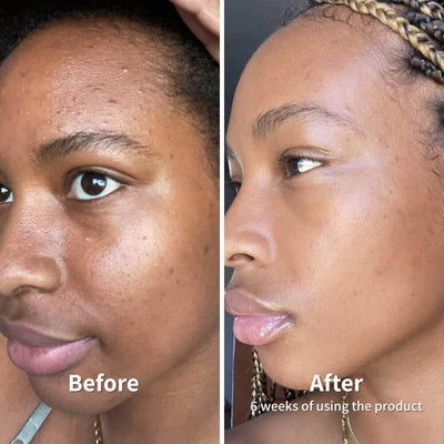 Peel Shot Deep Exfoliation Bundle